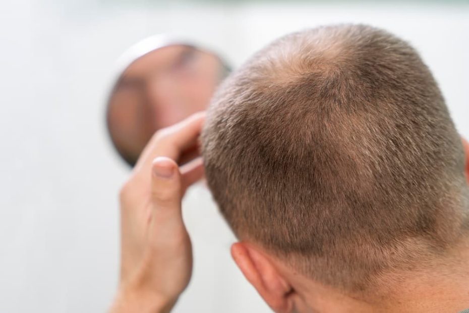 causas de la caída del cabello