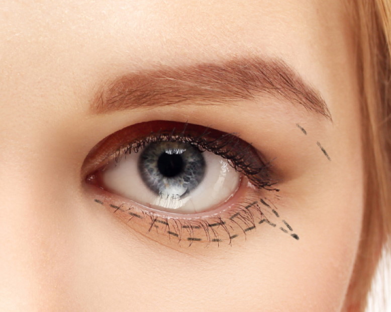 tratamiento-Cantopexia