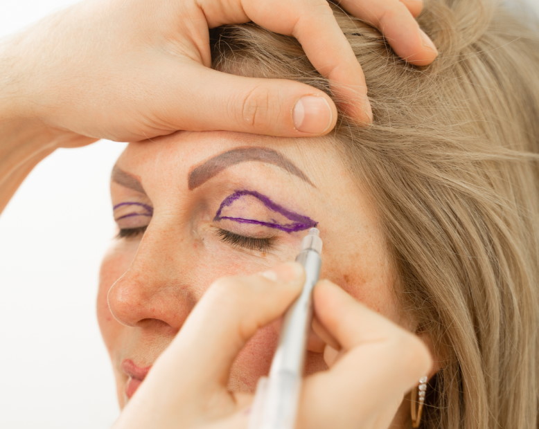 tratamiento-blefaroplastia-superior