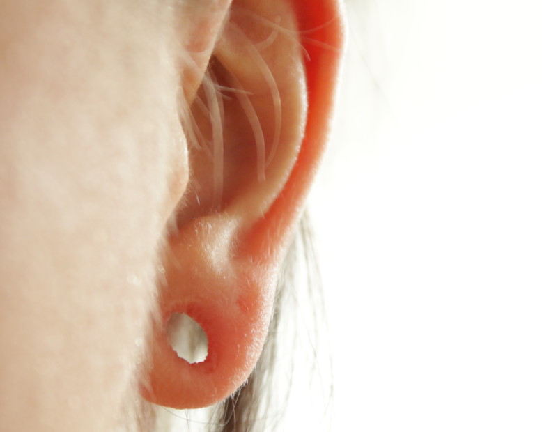 tratamiento-lobuloplastia