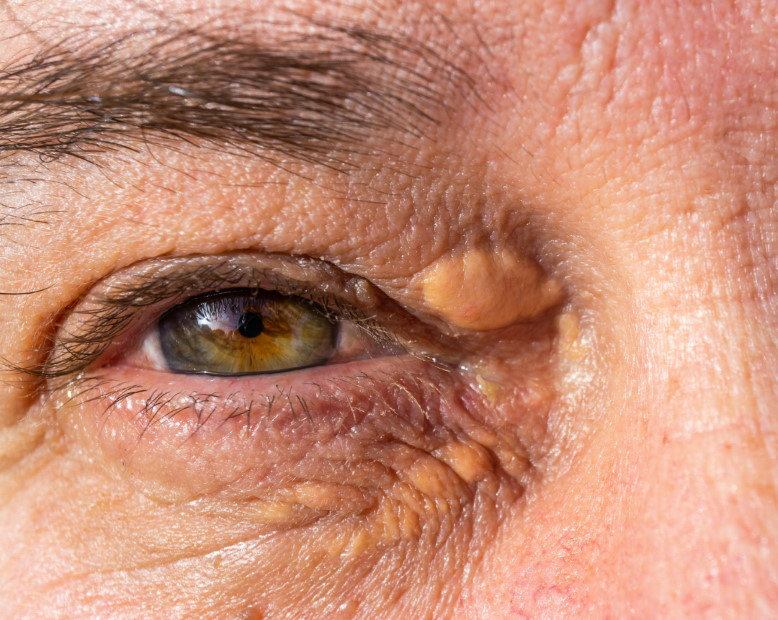 tratamiento-xantelasmas