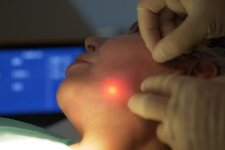 Tratamiento de resurfacing con láser híbrido Alma Hybrid en Ártica Medicina Estética, Viveiro Lugo